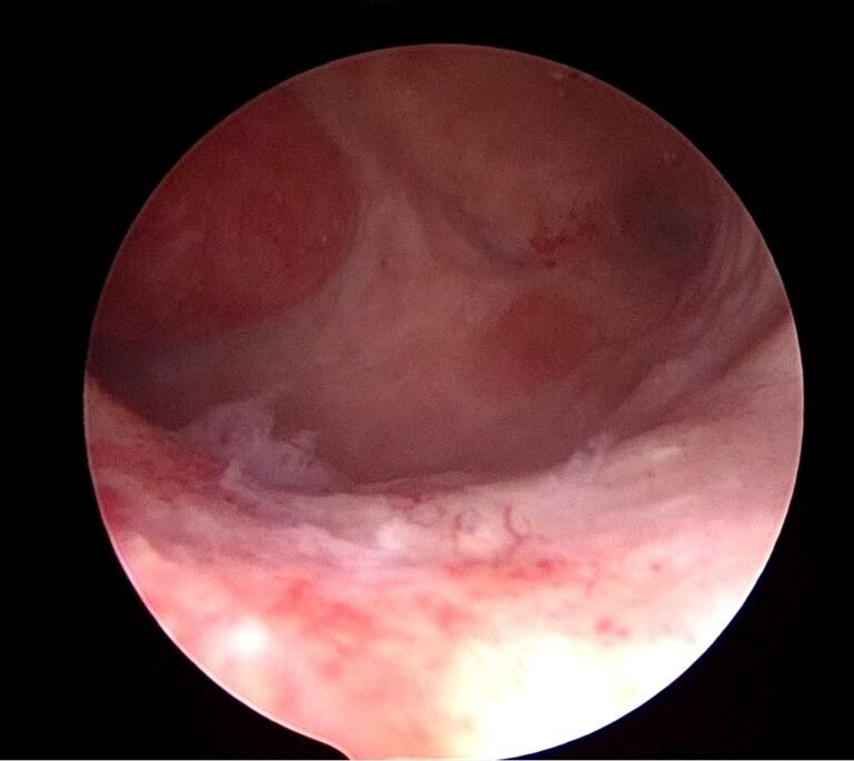 Copertina del video: Biopsy Snake Grasper sec. VITALE