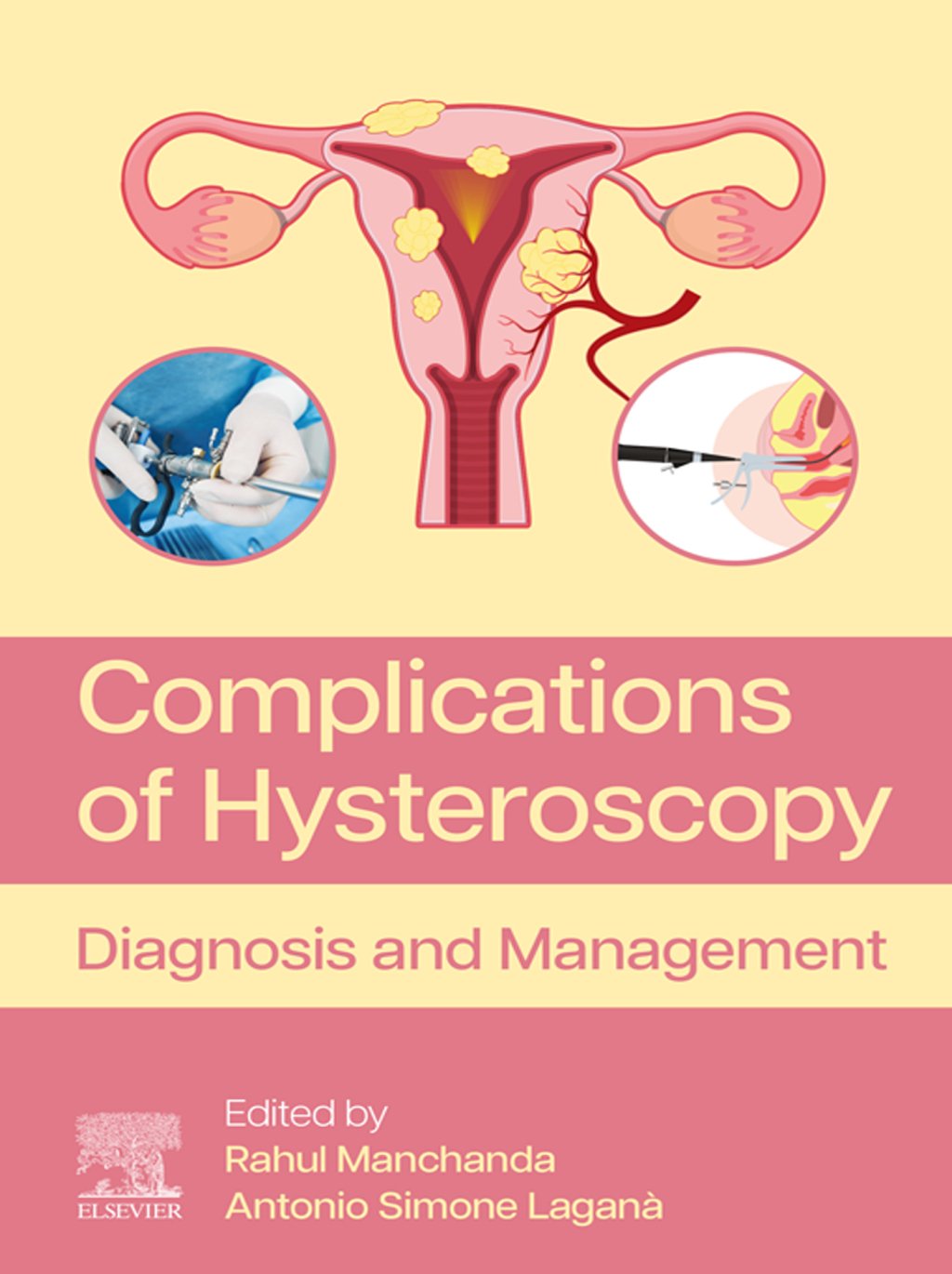 Cover - Complications of Hysteroscopy. Diagnosis and Management